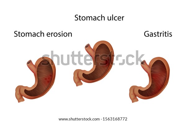 Gastritis Stomach Ulcer Erosion Abdominal Inflammation Stock ...