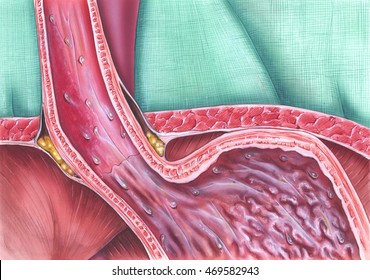 Gastroesophageal Reflux Disease (GERD), Caused When The Lower Esophageal Sphincter (LES) Does Not Close Properly, And Stomach Contents Leak Back (reflux) Into The Esophagus.