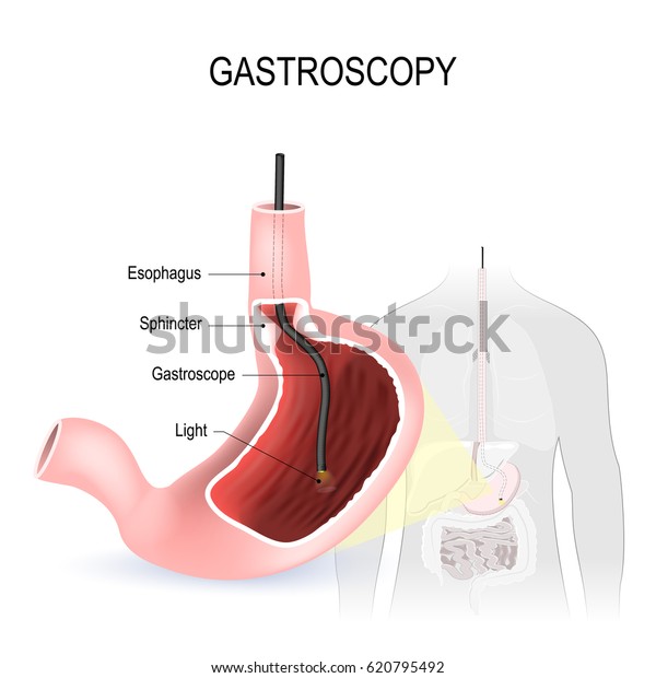 Gastroscopy Esophagoscopy Duodenoscopy Diagnostic Procedure Endoscope ...