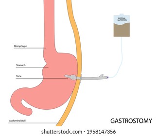 Gastrostomy Tube For Enteral Nutrition. Gastro Anatomy