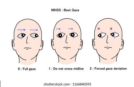 Gaze Preference Is The Important Sign In Clinical Examination For Acute Stroke Patient. It Is Helpful To Determine The Extension And Location Of Brain Lesion. Patient Will Gaze To One Side Of Body. 