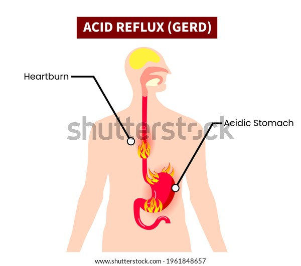 Gerd Acid Reflux Human Stomach Esophagus Stock Illustration 1961848657