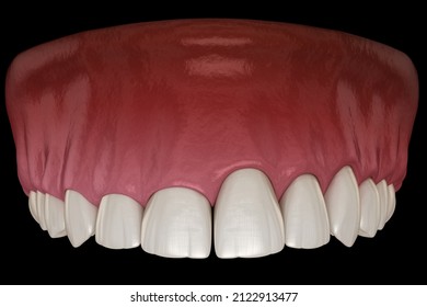 Gingivectomy Surgery With Laser Using.  Medically Accurate Tooth 3D Illustration