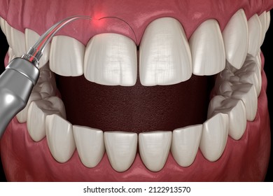 Gingivectomy Surgery With Laser Using.  Medically Accurate Tooth 3D Illustration