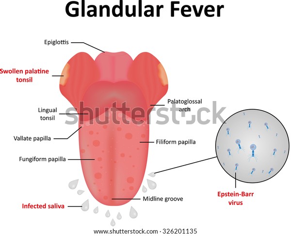 Glandular Fever Stock Illustration 326201135