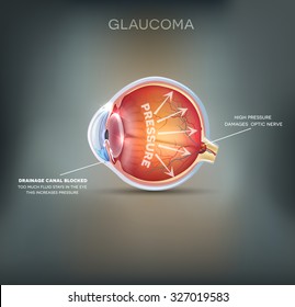 Glaucoma detailed anatomy on an abstract grey mesh background.
