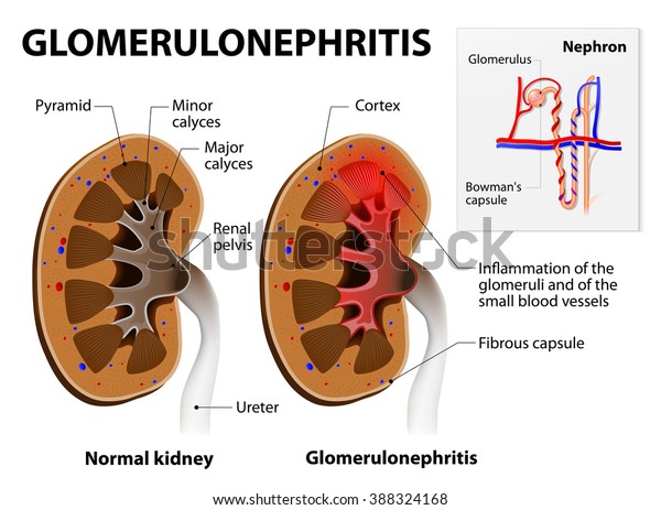 Glomerulonephritis Glomerular Nephritis Kidney Disease Stock ...