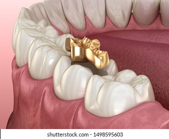 Golden Inlay Crown Fixation Over Tooth. Medically Accurate 3D Illustration Of Human Teeth Treatment