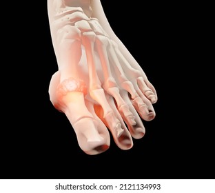 Gout Is A Common Form Of Inflammatory Arthritis On Human Feet Toe Finger 3d Rendering