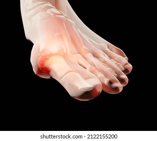 Gout Is A Common Form Of Inflammatory Arthritis On Human Feet Toe Finger 3d Rendering