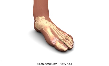Gout in feet 3d illustration