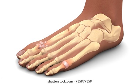 Gout In Feet 3d Illustration