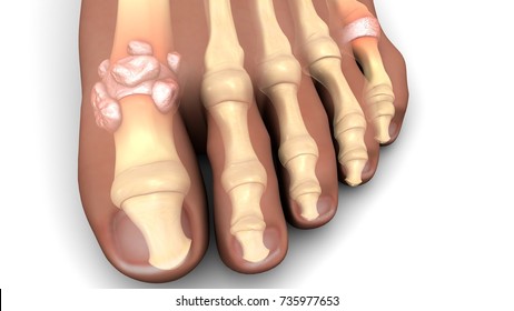 Gout In Feet 3d Illustration