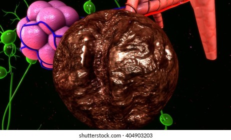 Granuloma 3d Illustration Stock Illustration 404903203 | Shutterstock