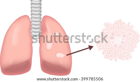 Granulomatous Lung Disease Stock photo © 