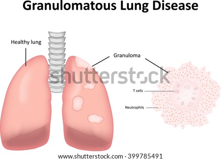 Granulomatous Lung Disease Labeled Diagram Stock photo © 