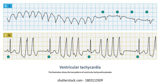 Sinus Tachycardia Images Stock Photos Vectors Shutterstock