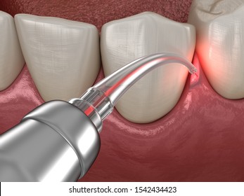 Gum Correction Surgery With Laser.  Medically Accurate Tooth 3D Illustration