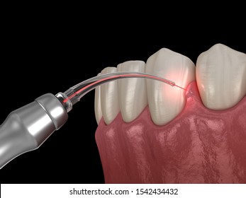 Gum Correction Surgery With Laser.  Medically Accurate Tooth 3D Illustration