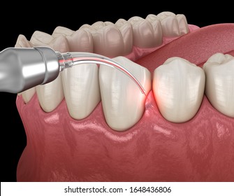 Gum Correction Surgery With Laser.  Medically Accurate Tooth 3D Illustration