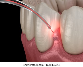 Gum Correction Surgery With Laser.  Medically Accurate Tooth 3D Illustration