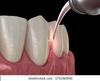 Gum Correction Surgery With Laser.  Medically Accurate Tooth 3D Illustration