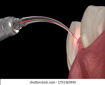 Gum Correction Surgery With Laser.  Medically Accurate Tooth 3D Illustration