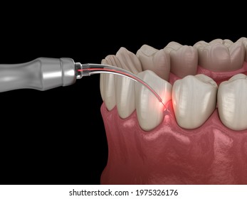 Gum Correction Surgery With Laser.  Medically Accurate Tooth 3D Illustration