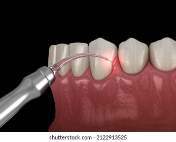 Gum Correction Surgery With Laser.  Medically Accurate Tooth 3D Illustration