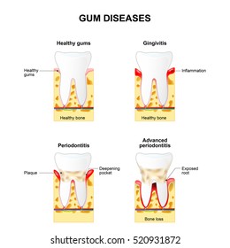 Gum Disease Gingivitis Periodontitis Stock Vector (Royalty Free) 498033025