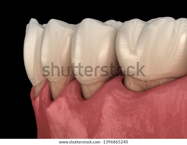 Gum\
recession process. Medically accurate 3D\
illustration