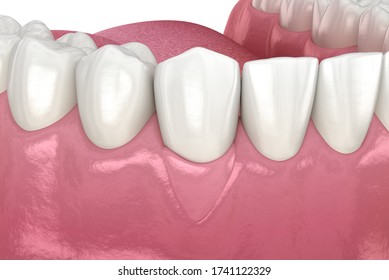 Gum Recession: Soft Tissue Graft Surgery. 3D Illustration Of Dental  Treatment