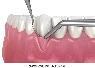 Gum Recession: Soft Tissue Graft Surgery. 3D Illustration Of Dental  Treatment