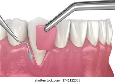 Gum Recession: Soft Tissue Graft Surgery. 3D Illustration Of Dental  Treatment