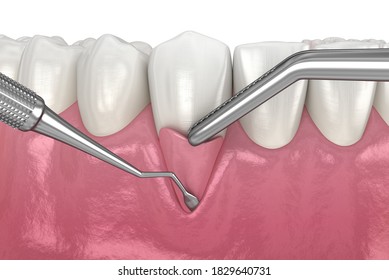 Gum Recession: Soft Tissue Graft Surgery. 3D Illustration Of Dental  Treatment