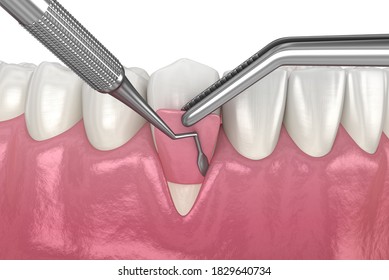 Gum Recession: Soft Tissue Graft Surgery. 3D Illustration Of Dental  Treatment