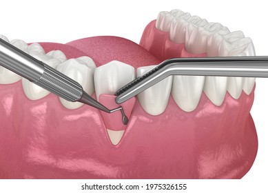 Gum Recession: Soft Tissue Graft Surgery. 3D Illustration Of Dental  Treatment