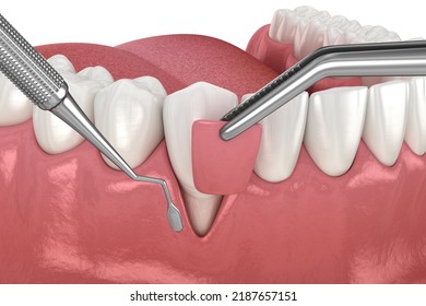 Gum Recession: Soft Tissue Graft Surgery. 3D Illustration Of Dental  Treatment