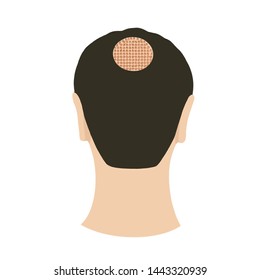 Hair Transplantation Alopecia Crown Zone Thinning Stock Illustration ...