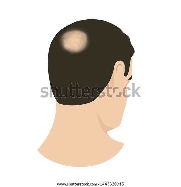 Hair Transplantation Alopecia Crown Zone Thinning Stock Illustration ...