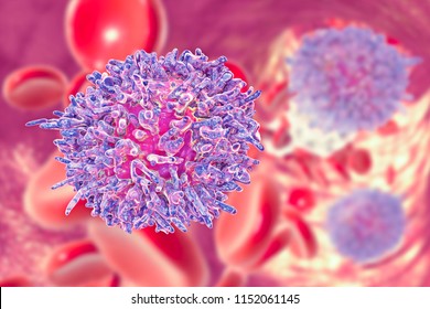 Hairy Cell Leukemia, 3D Illustration. It Is A Hematological Malignancy, Chronic Lymphocytic Leukemia, With Accumulation Of Abnormal B Lymphocytes