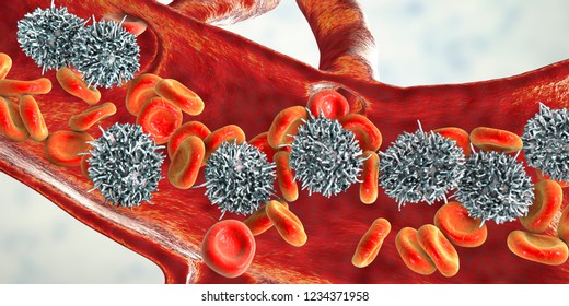 Hairy Cell Leukemia, 3D Illustration. It Is A Hematological Malignancy, Chronic Lymphocytic Leukemia, With Accumulation Of Abnormal B Lymphocytes