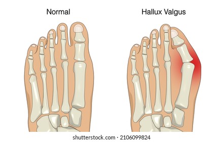 426 Bunions Illustration Images, Stock Photos & Vectors 