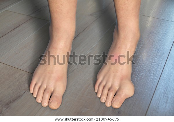 hallux valgus, or bunion. 3D\
illustration showing normal female foot and female foot with\
bunion
