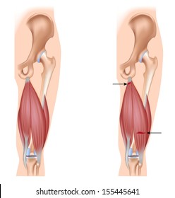 Hamstring Injury