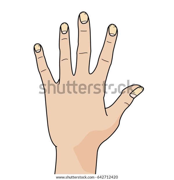 Hand Bad Cracked Nails On White Stock Illustration 642712420