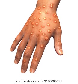 Hand of a patient with monkeypox infection, 3D illustration. Monkeypox is a zoonotic virus from Poxviridae family, causes monkeypox, a pox-like disease