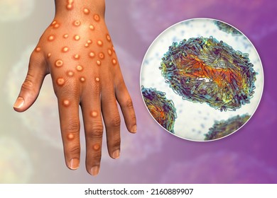 Hand of a patient with monkeypox infection, 3D illustration. Monkeypox is a zoonotic virus from Poxviridae family, causes monkeypox, a pox-like disease
