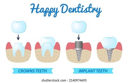 Happy Dentistry Poster. Icons Installation Of The Crown On The Tooth Or Implant.   Illustration Isolated On White,