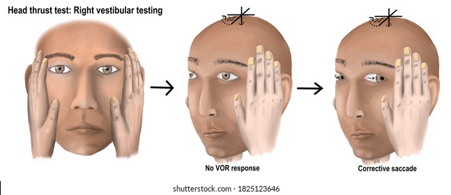 head thrust test is neurological physical examination testing vestibular nerve function.